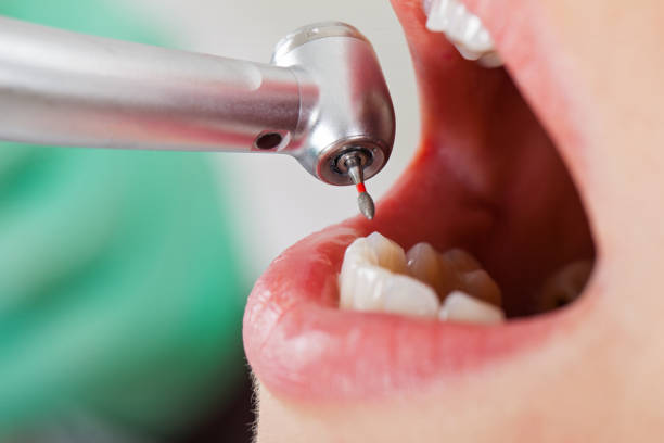 Best Chipped Tooth Repair Near Me  in De Soto, IA